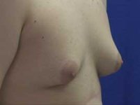 gynecomastia_17_05.jpg